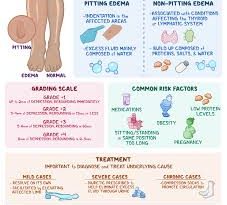 How to Deal with Edema in Legs