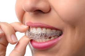 The Advantages of Invisalign: When to Think about Clear Aligners